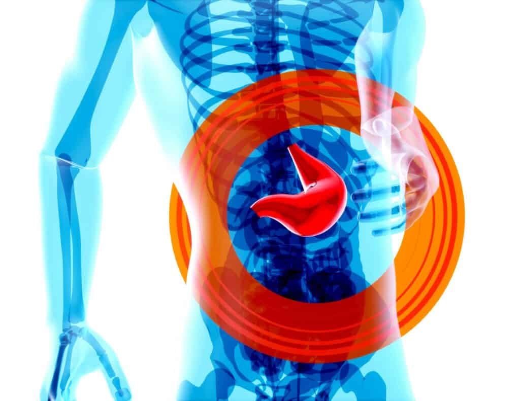 Stomach Cancer