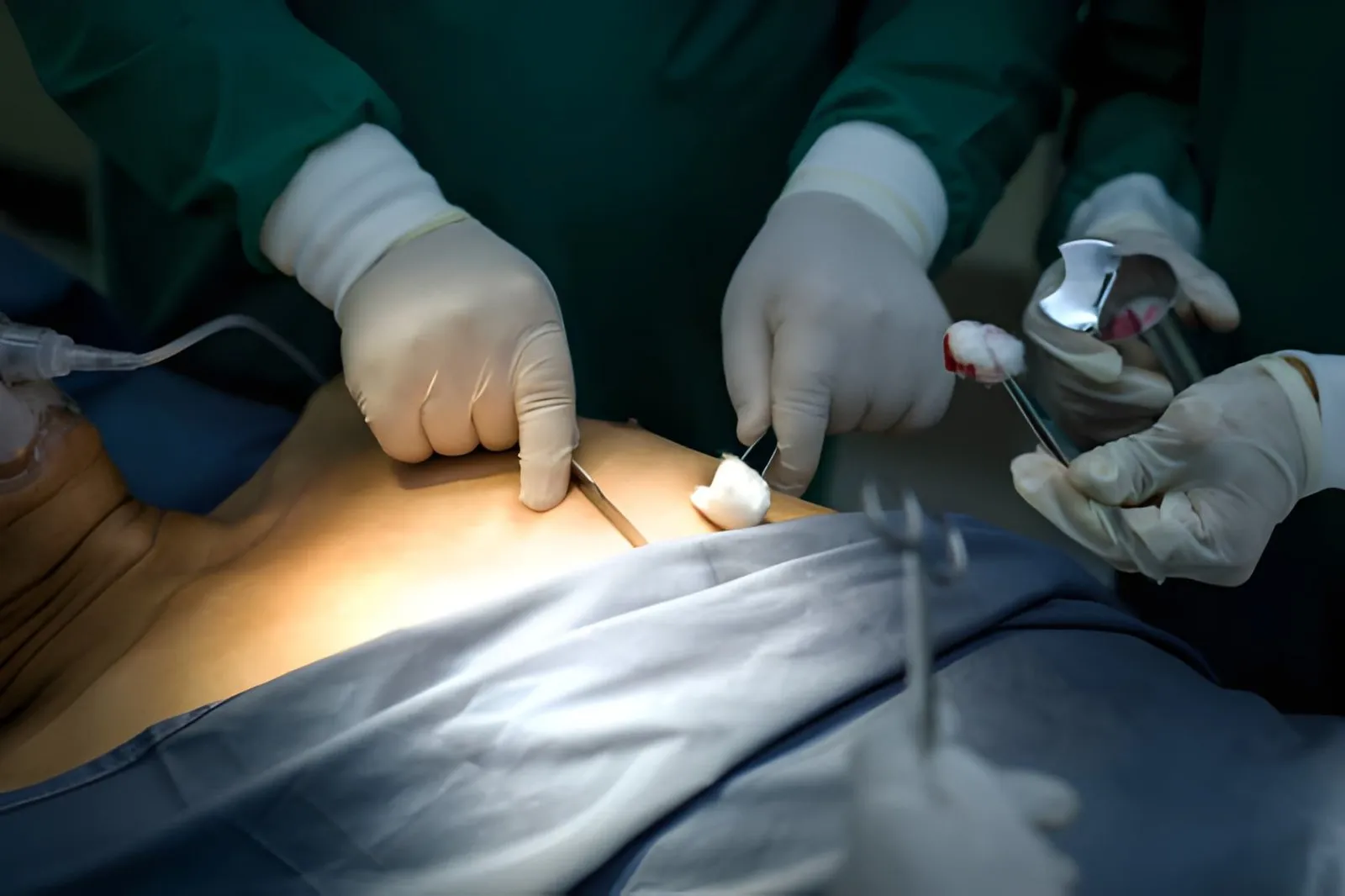 hernia surgery malpractice