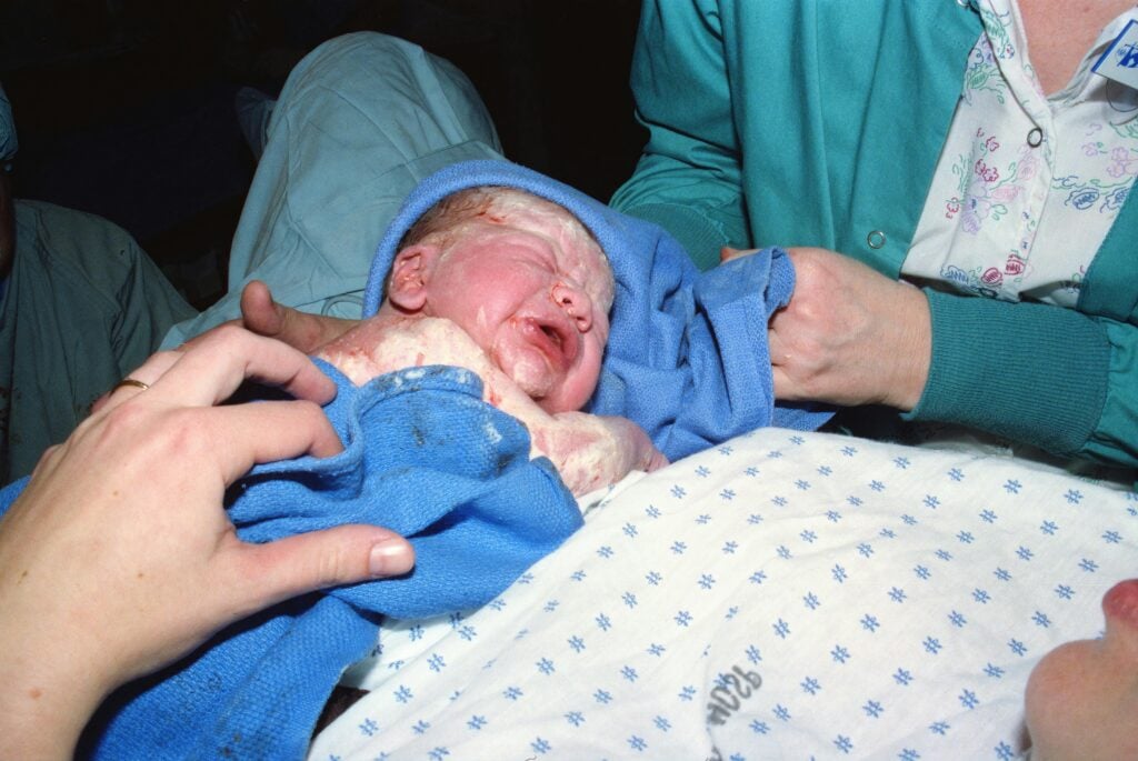 Newborn being handled after delivery, highlighting potential birth injury medical malpractice.