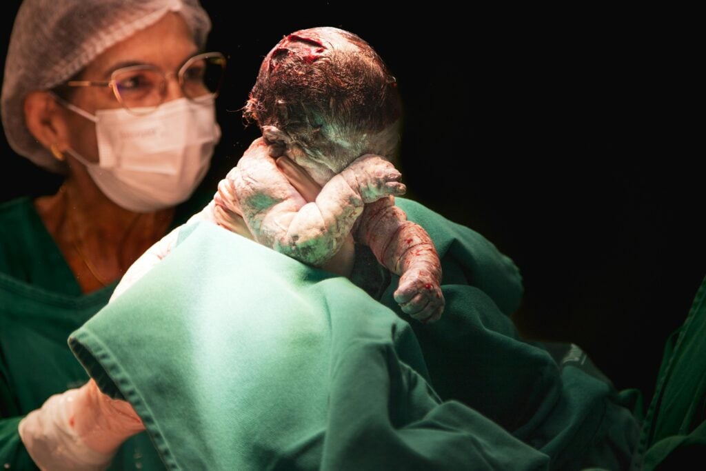 A newborn being delivered using forceps, potentially leading to forceps birth injury.