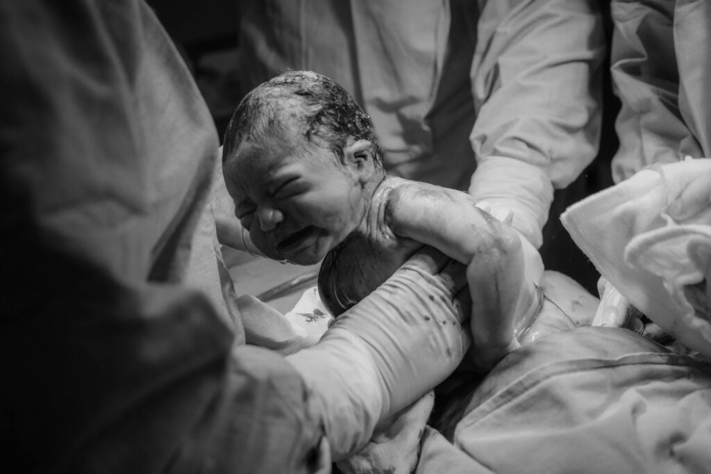 Newborn with shoulder dystocia assisted by medical staff during difficult birth.
