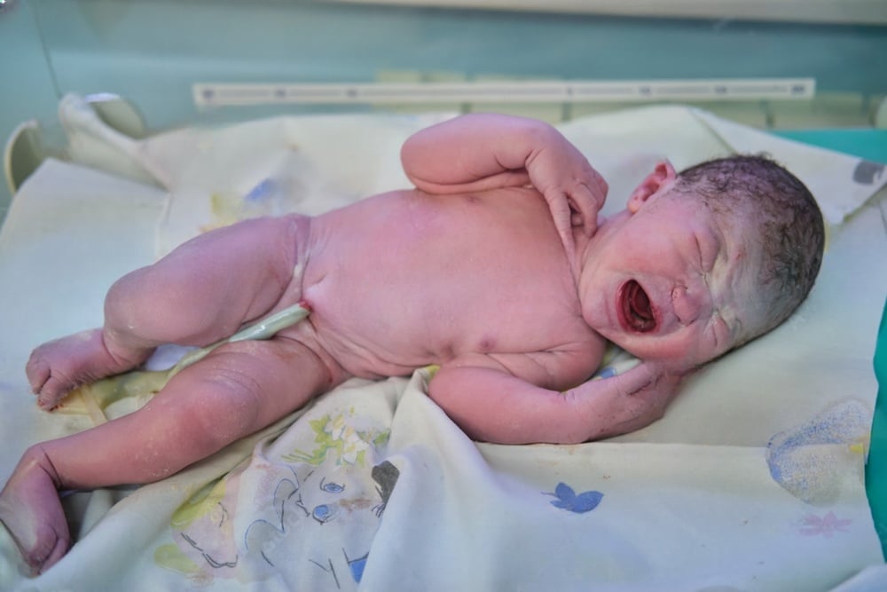 Newborn baby crying after birth, potentially linked to an umbilical cord birth injury.