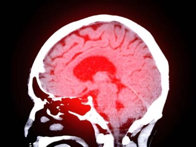 CT scan of the brain