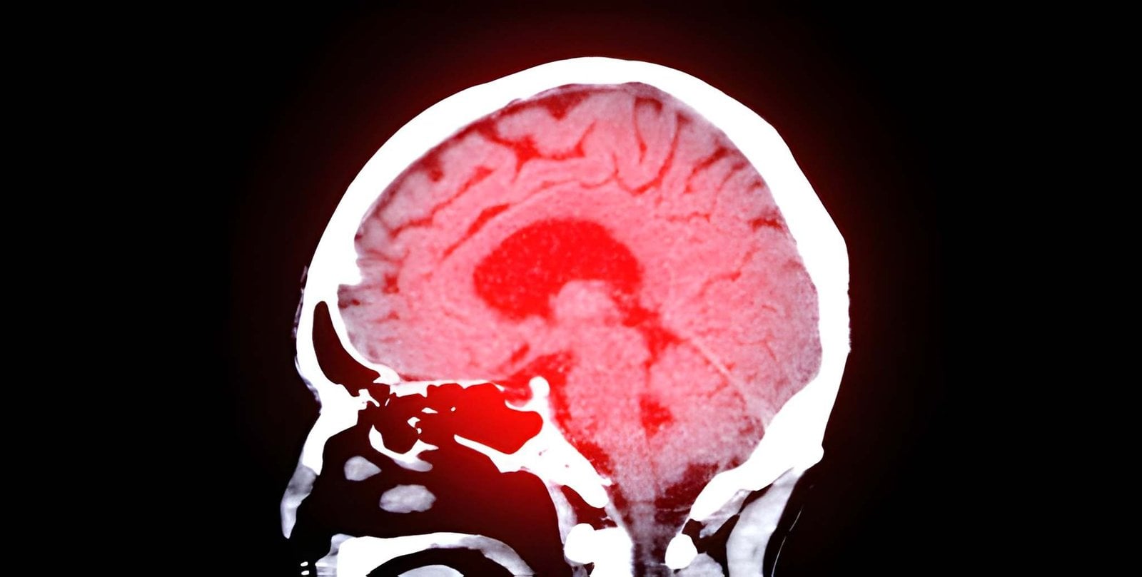 CT scan of the brain
